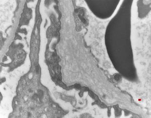 F,14y. | Alport syndrome - split and laminated, thick/thin basement membranes F,14y. | Alport syndrome - split and laminated, thick/thin basement membranes